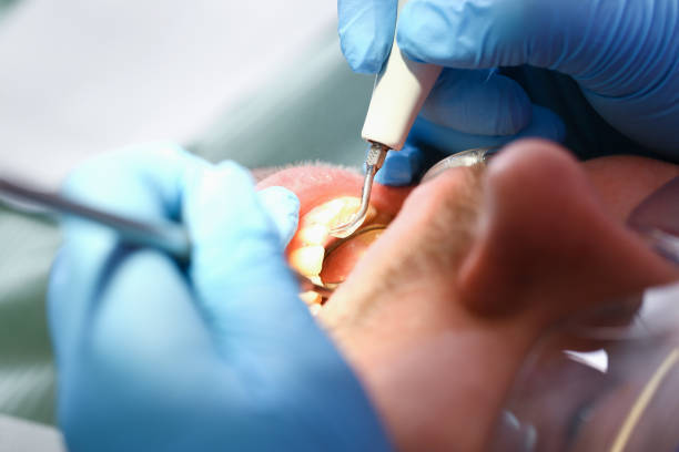 Best Dental Abscess Treatment in Wyoming, OH